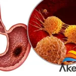 Akeso's Cadonilimab Wins FDA Nod for Global Phase 3 Gastric Cancer Study