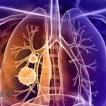 Hansoh Licenses EGFR Drug Aumolertinib to Glenmark for $1B+ in Milestones