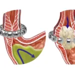 Cryofocus GERD System Secures NMPA Approval in China