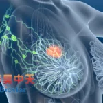 Biostar Technologies Doses First Patient in US Pivotal Trial for Utedelone in Breast Cancer Brain Mets