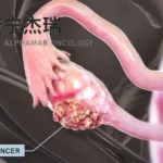 Alphamab JSKN003 ADC FDA Breakthrough Therapy Targets Ovarian Cancer