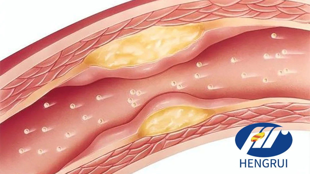 Hengrui's HRS-5346 Lp(a) Inhibitor Gets China Breakthrough Therapy Designation in $1.97B Merck Deal