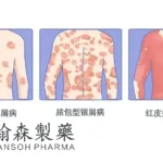 Hansoh's Selective TYK2 Inhibitor HS‑10374 Hits Co‑Primary Endpoints in Pivotal Phase III Psoriasis Trial – Over Half of Patients Reach PASI 90 at Week 16