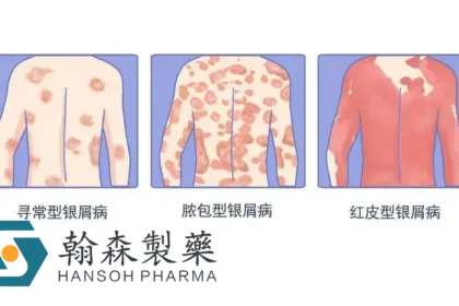 Hansoh's Selective TYK2 Inhibitor HS‑10374 Hits Co‑Primary Endpoints in Pivotal Phase III Psoriasis Trial – Over Half of Patients Reach PASI 90 at Week 16