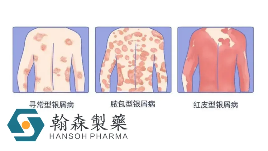Hansoh's Selective TYK2 Inhibitor HS‑10374 Hits Co‑Primary Endpoints in Pivotal Phase III Psoriasis Trial – Over Half of Patients Reach PASI 90 at Week 16