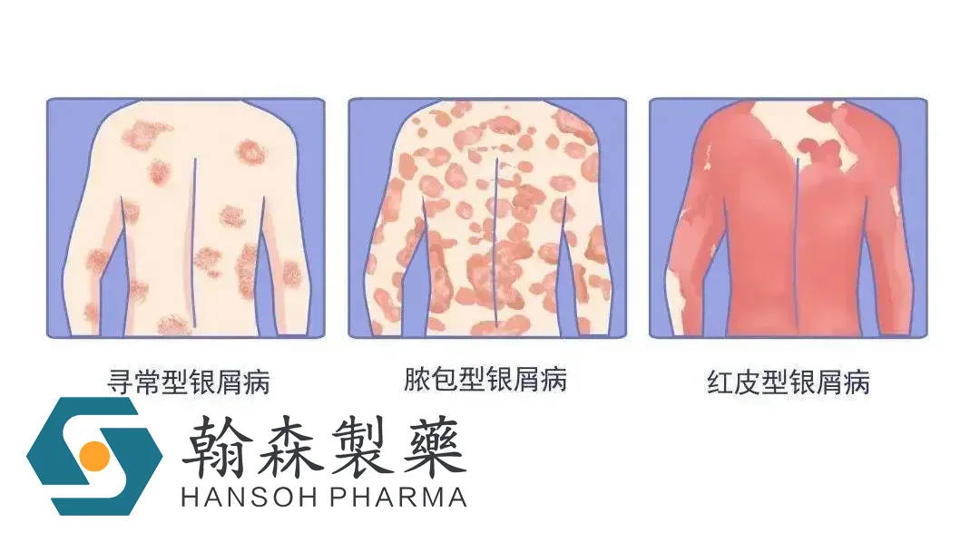 Hansoh's Selective TYK2 Inhibitor HS‑10374 Hits Co‑Primary Endpoints in Pivotal Phase III Psoriasis Trial – Over Half of Patients Reach PASI 90 at Week 16