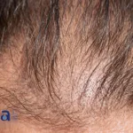 Cutia Therapeutics Secures Macao Marketing Approval for CU‑40102 Topical Finasteride Spray – Completing Greater China Rollout in Androgenetic Alopecia