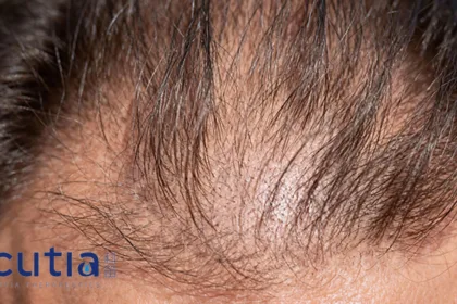 Cutia Therapeutics Secures Macao Marketing Approval for CU‑40102 Topical Finasteride Spray – Completing Greater China Rollout in Androgenetic Alopecia