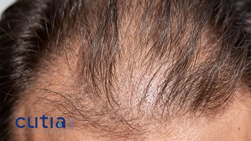 Cutia Therapeutics Secures Macao Marketing Approval for CU‑40102 Topical Finasteride Spray – Completing Greater China Rollout in Androgenetic Alopecia