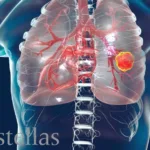 Astellas Doses First Patient in Phase 3 Trial of Setidegrasib Versus Docetaxel – First Pivotal Test of a KRAS G12D Degrader in Pretreated NSCLC