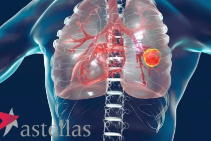 Astellas Doses First Patient in Phase 3 Trial of Setidegrasib Versus Docetaxel – First Pivotal Test of a KRAS G12D Degrader in Pretreated NSCLC