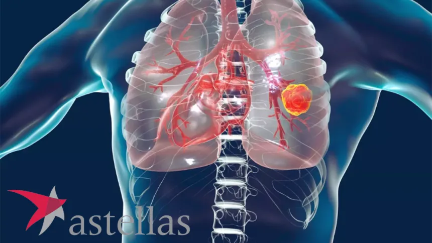 Astellas Doses First Patient in Phase 3 Trial of Setidegrasib Versus Docetaxel – First Pivotal Test of a KRAS G12D Degrader in Pretreated NSCLC