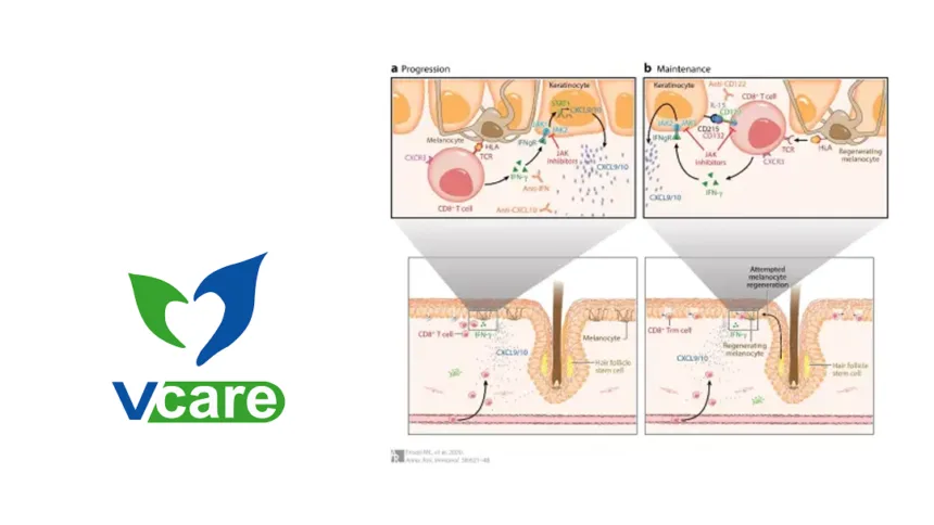 Jiangsu Vcare's VC005 JAK1 Inhibitor Wins CDE IND Approval for Seborrheic Dermatitis – Fourth Topical Indication for Next‑Generation Molecule